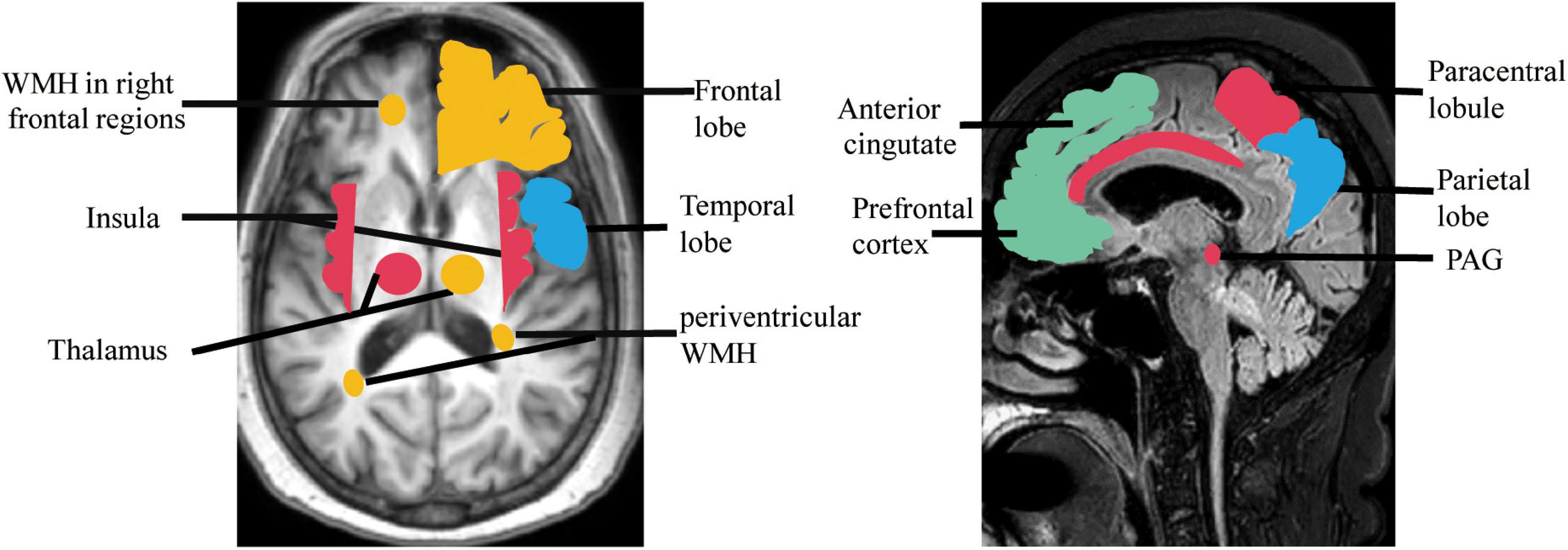 Urinary dysfunction in patients with vascular cognitive impairment